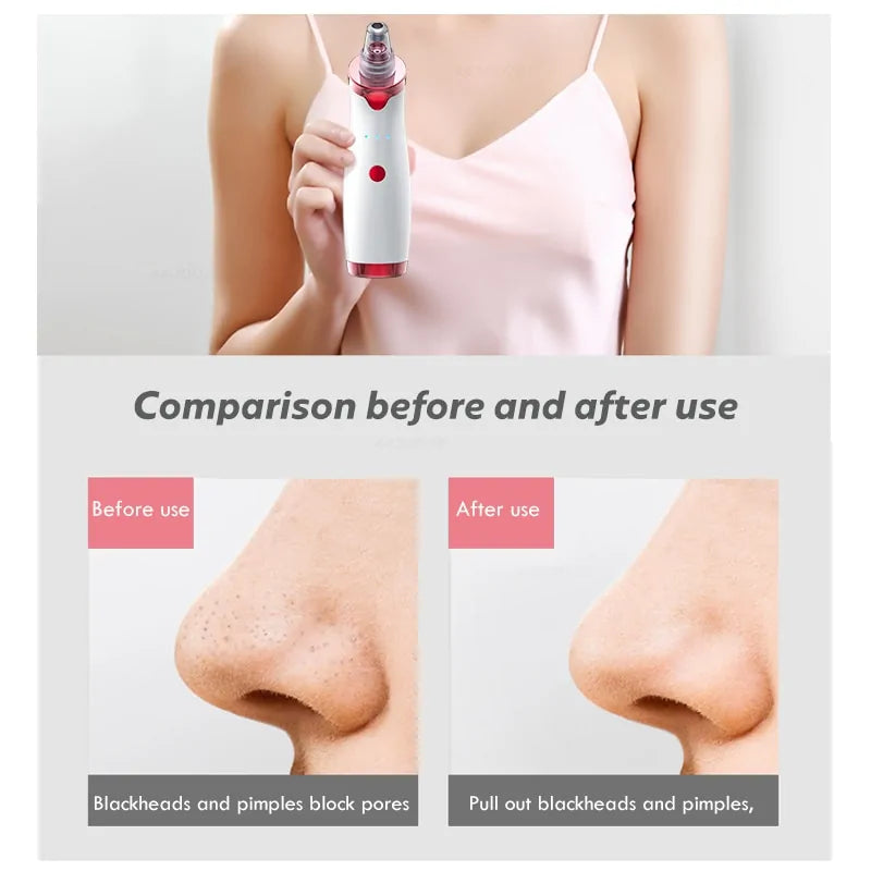 Blackhead Remover & Deep Nose Cleaner